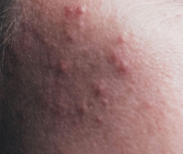 Adult Acne Do’s + Don’ts