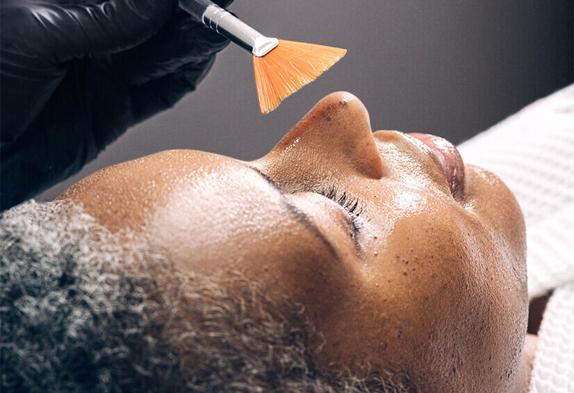 Chemical Peels