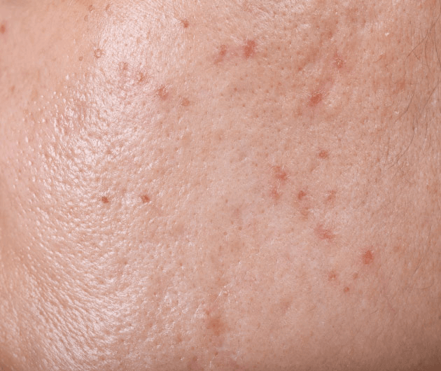 How Adult Acne Forms
